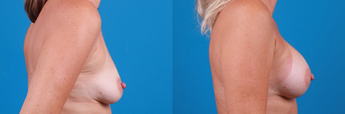 Breast Augmentation Before & After Gallery - Patient 402439 - Image 3