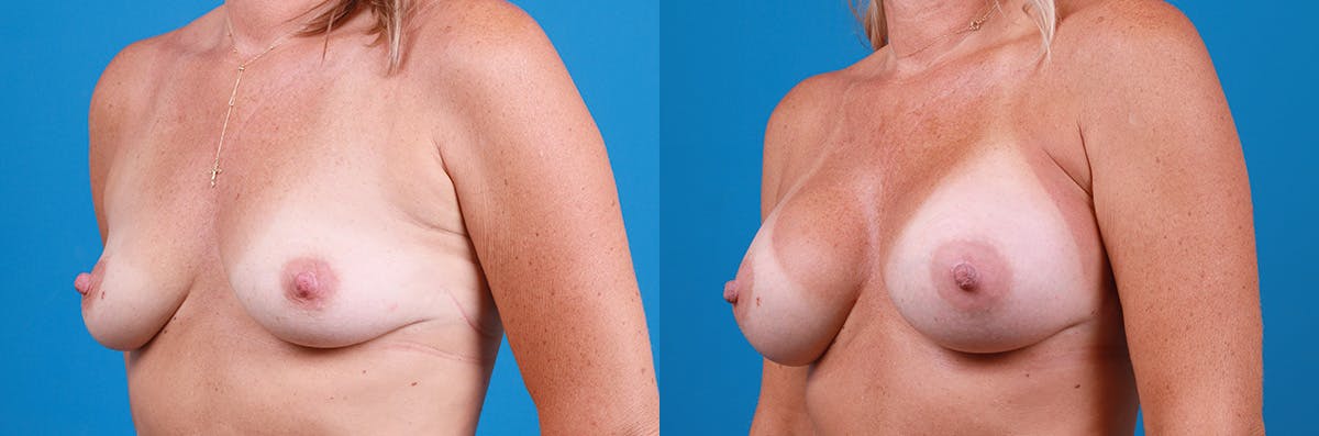 Breast Augmentation Before & After Gallery - Patient 402439 - Image 4