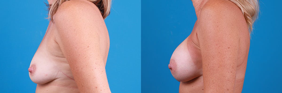 Breast Augmentation Before & After Gallery - Patient 402439 - Image 5
