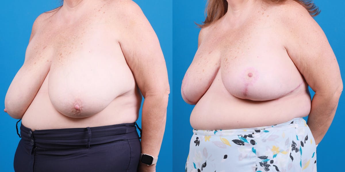 Breast Reduction Before & After Gallery - Patient 649655 - Image 2