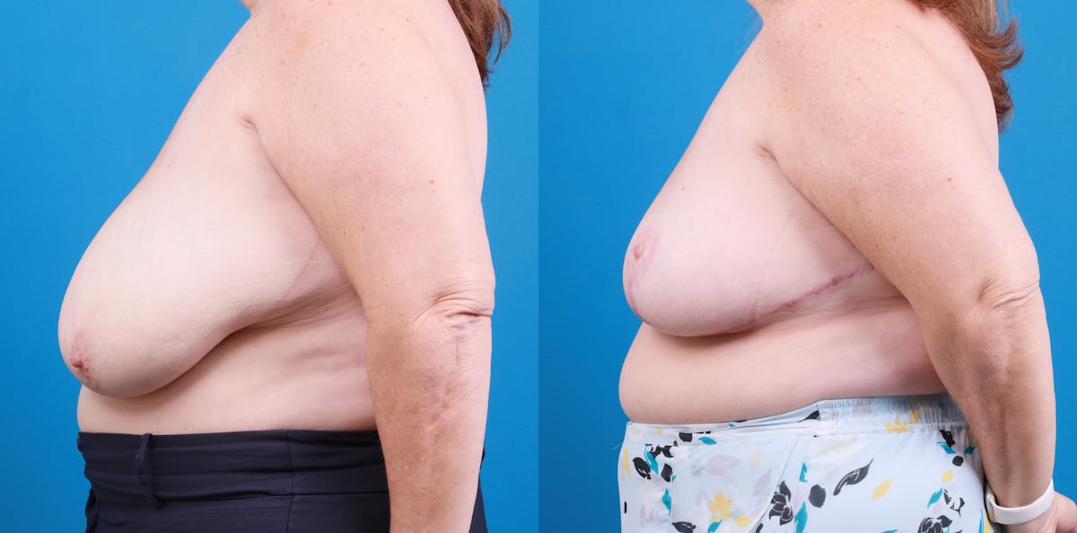 Breast Reduction Before & After Gallery - Patient 649655 - Image 3