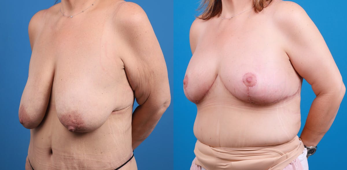 Breast Lift Before & After Gallery - Patient 147329 - Image 2