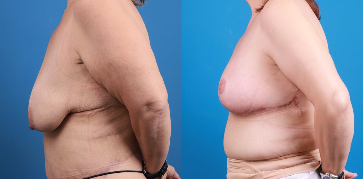 Breast Lift Before & After Gallery - Patient 147329 - Image 3