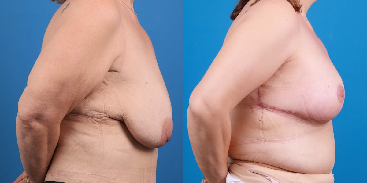 Breast Lift Before & After Gallery - Patient 147329 - Image 5