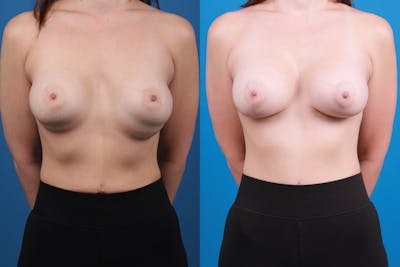 Breast Revision Before & After Gallery - Patient 922071 - Image 1