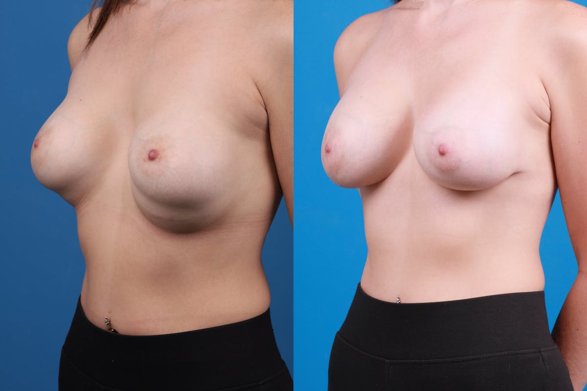Breast Revision Before & After Gallery - Patient 922071 - Image 2
