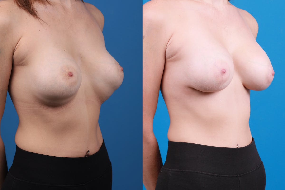Breast Revision Before & After Gallery - Patient 922071 - Image 3