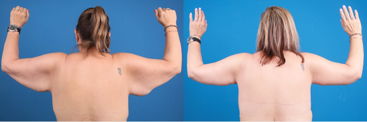Arm Lift Before & After Gallery - Patient 248068 - Image 3