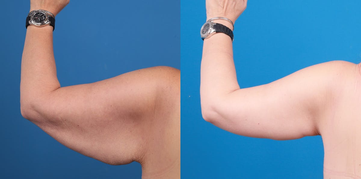 Arm Lift Before & After Gallery - Patient 248068 - Image 1