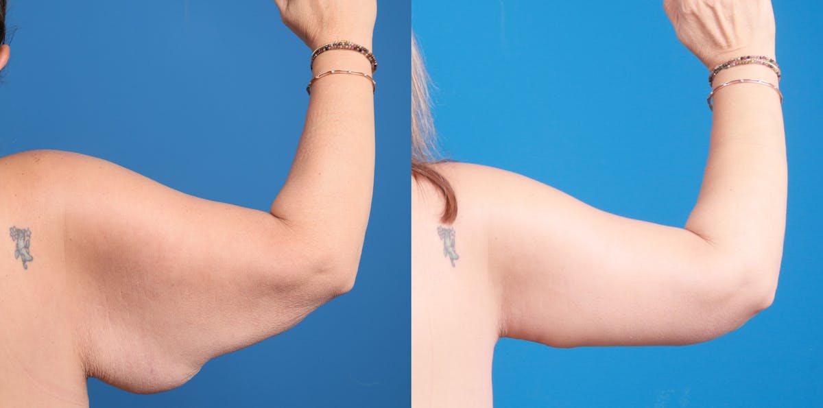 Arm Lift Before & After Gallery - Patient 248068 - Image 2