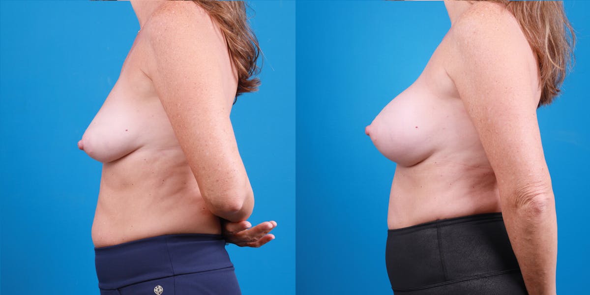 Breast Augmentation Before & After Gallery - Patient 236059 - Image 3