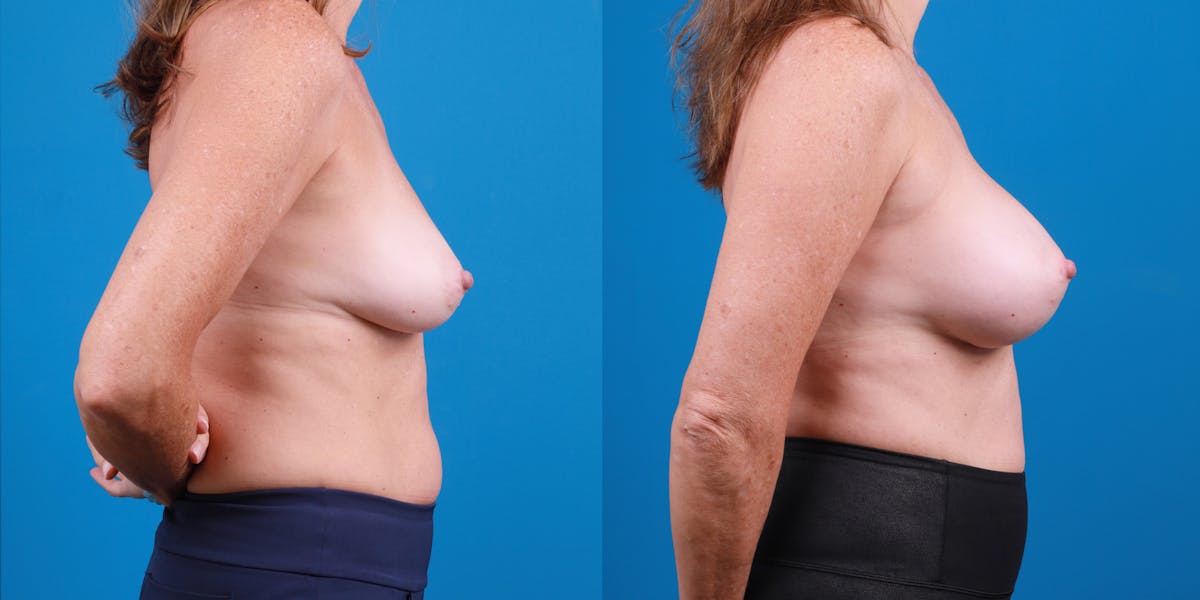 Breast Augmentation Before & After Gallery - Patient 236059 - Image 5