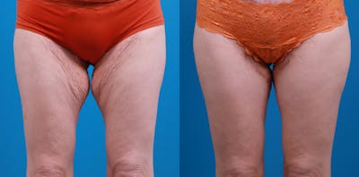 Thigh Lift Before & After Gallery - Patient 211267 - Image 1