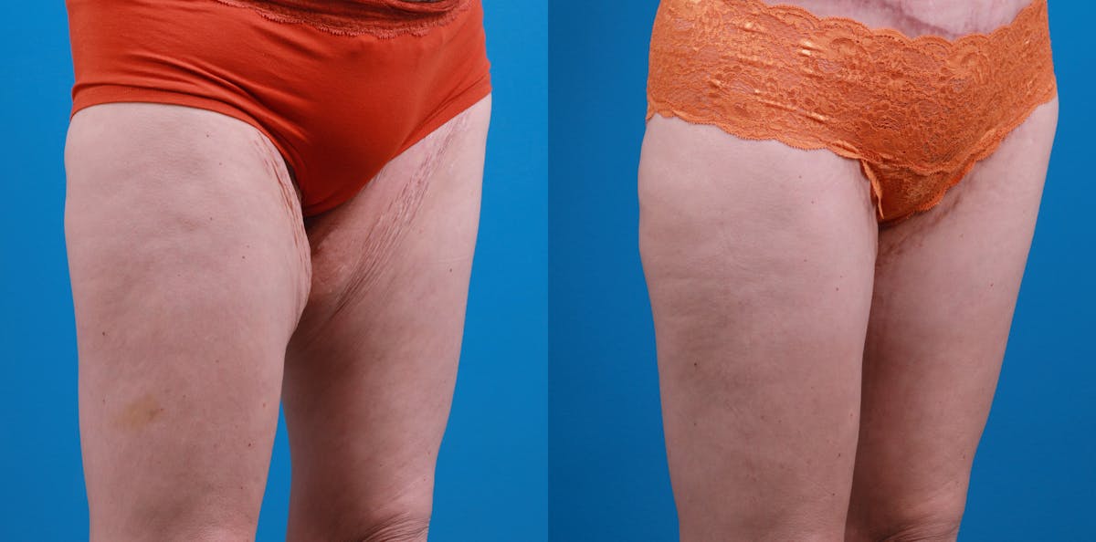 Thigh Lift Before & After Gallery - Patient 211267 - Image 2