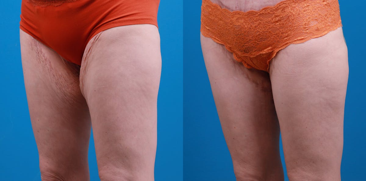 Thigh Lift Before & After Gallery - Patient 211267 - Image 3