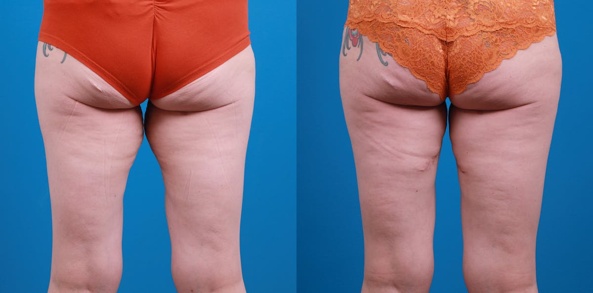 Thigh Lift Before & After Gallery - Patient 211267 - Image 4