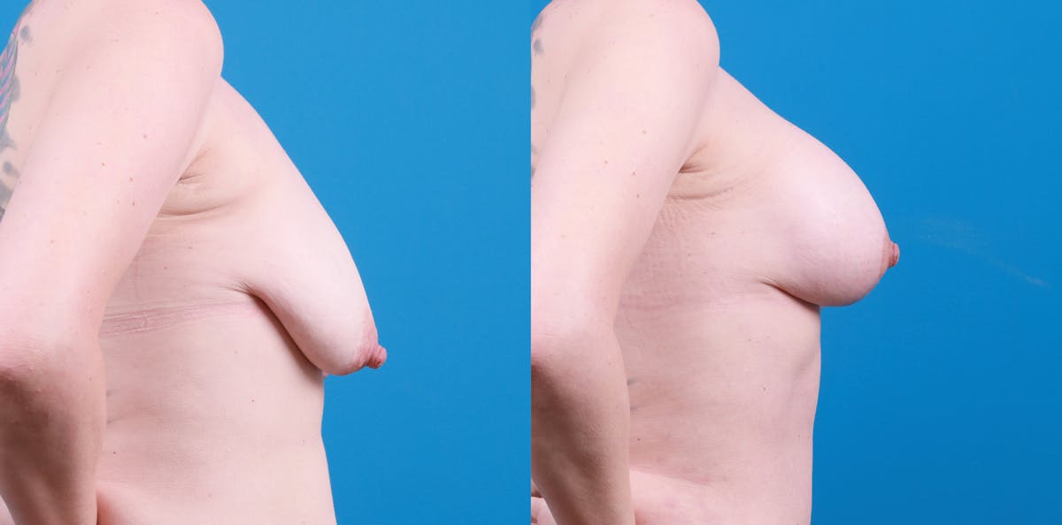 Breast Augmentation and Lift Before & After Gallery - Patient 247955 - Image 3
