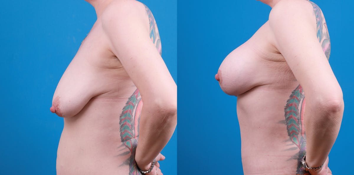 Breast Augmentation and Lift Before & After Gallery - Patient 247955 - Image 5
