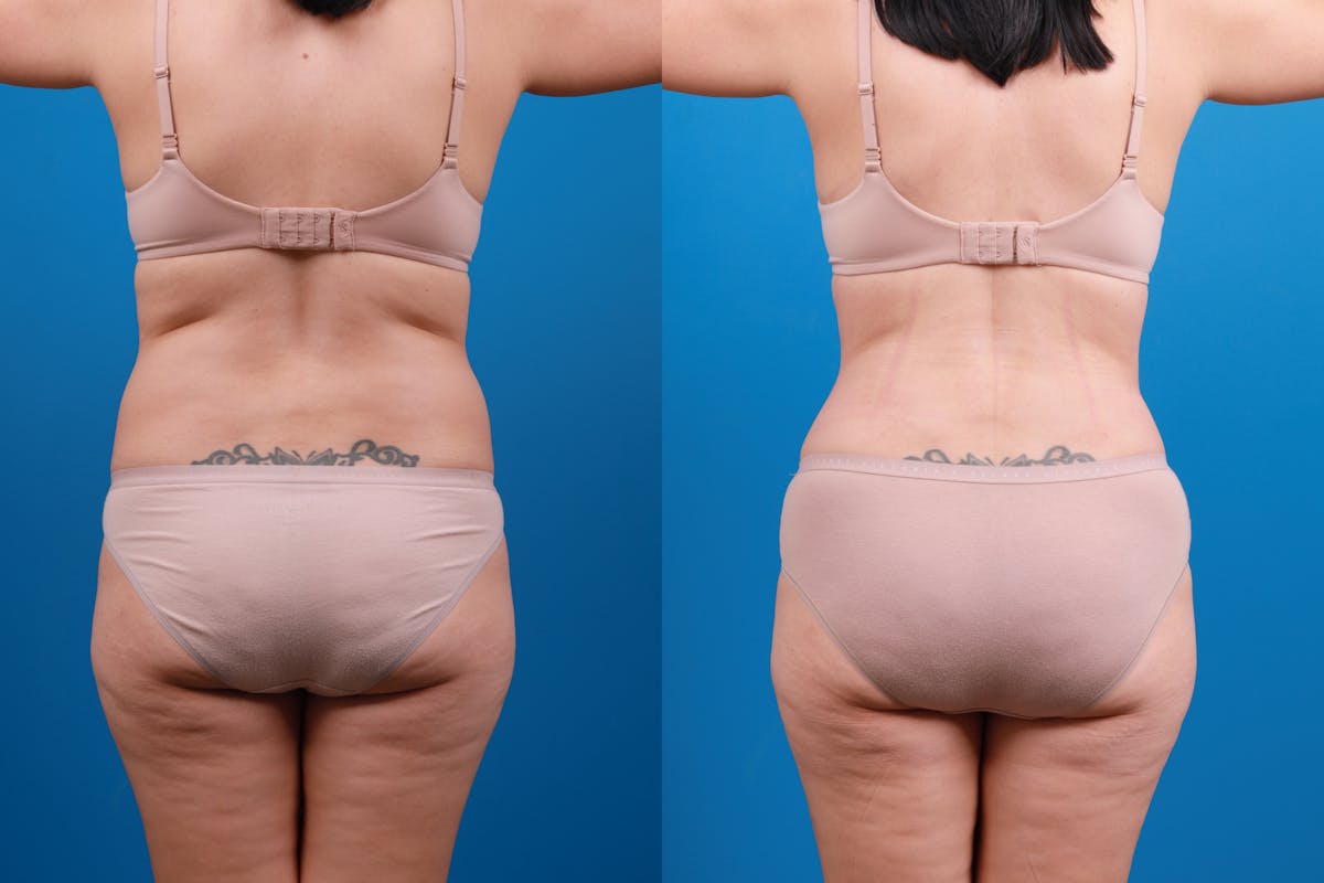 Liposuction Before & After Gallery - Patient 388989 - Image 1