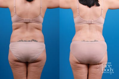 Hidden Liposuction  Before & After Gallery - Patient 376294 - Image 1
