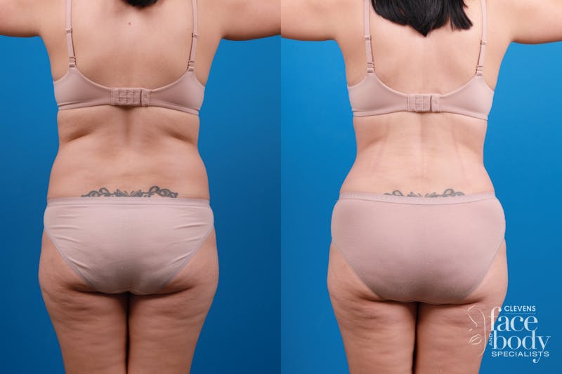 Hidden Liposuction  Before & After Gallery - Patient 376294 - Image 1
