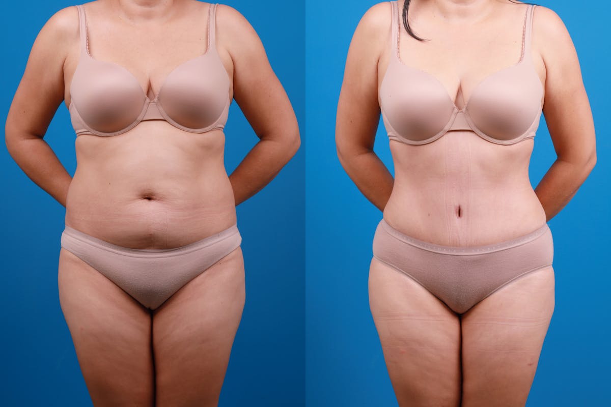 Tummy Tuck Before & After Gallery - Patient 840104 - Image 1