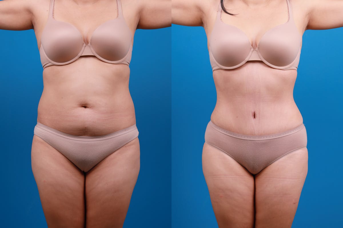 Tummy Tuck Before & After Gallery - Patient 115108 - Image 2