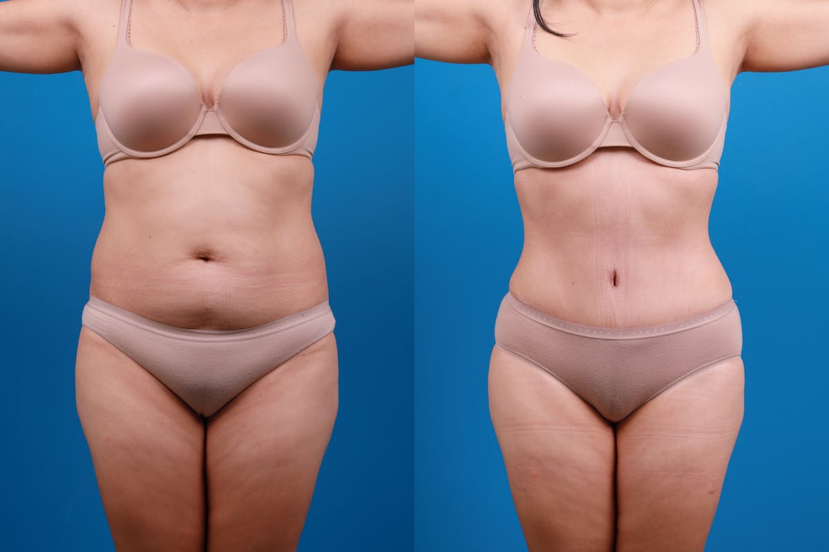 Tummy Tuck Before & After Gallery - Patient 840104 - Image 2