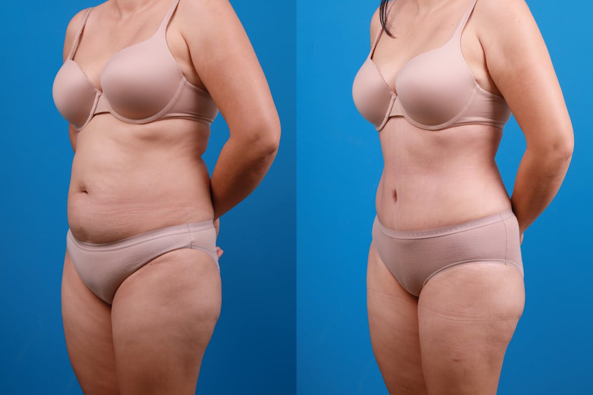 Tummy Tuck Before & After Gallery - Patient 840104 - Image 4
