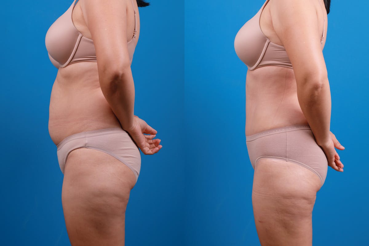Tummy Tuck Before & After Gallery - Patient 115108 - Image 5