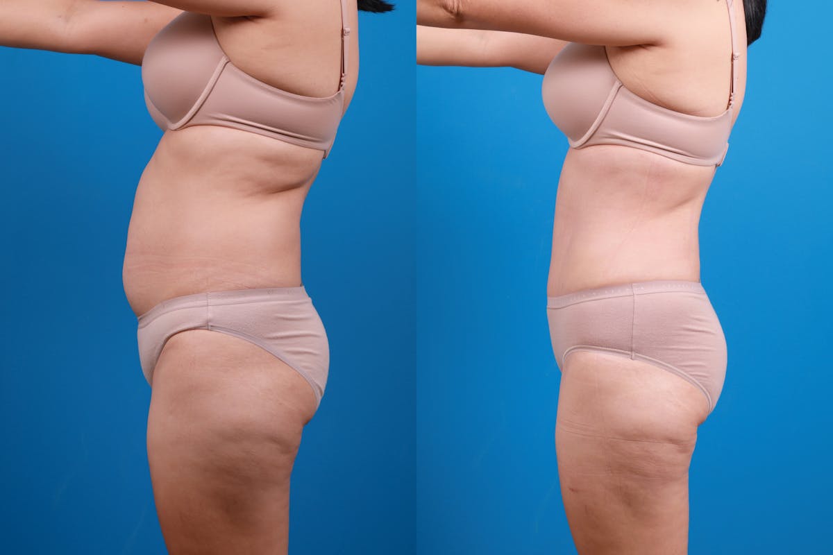 Tummy Tuck Before & After Gallery - Patient 840104 - Image 6