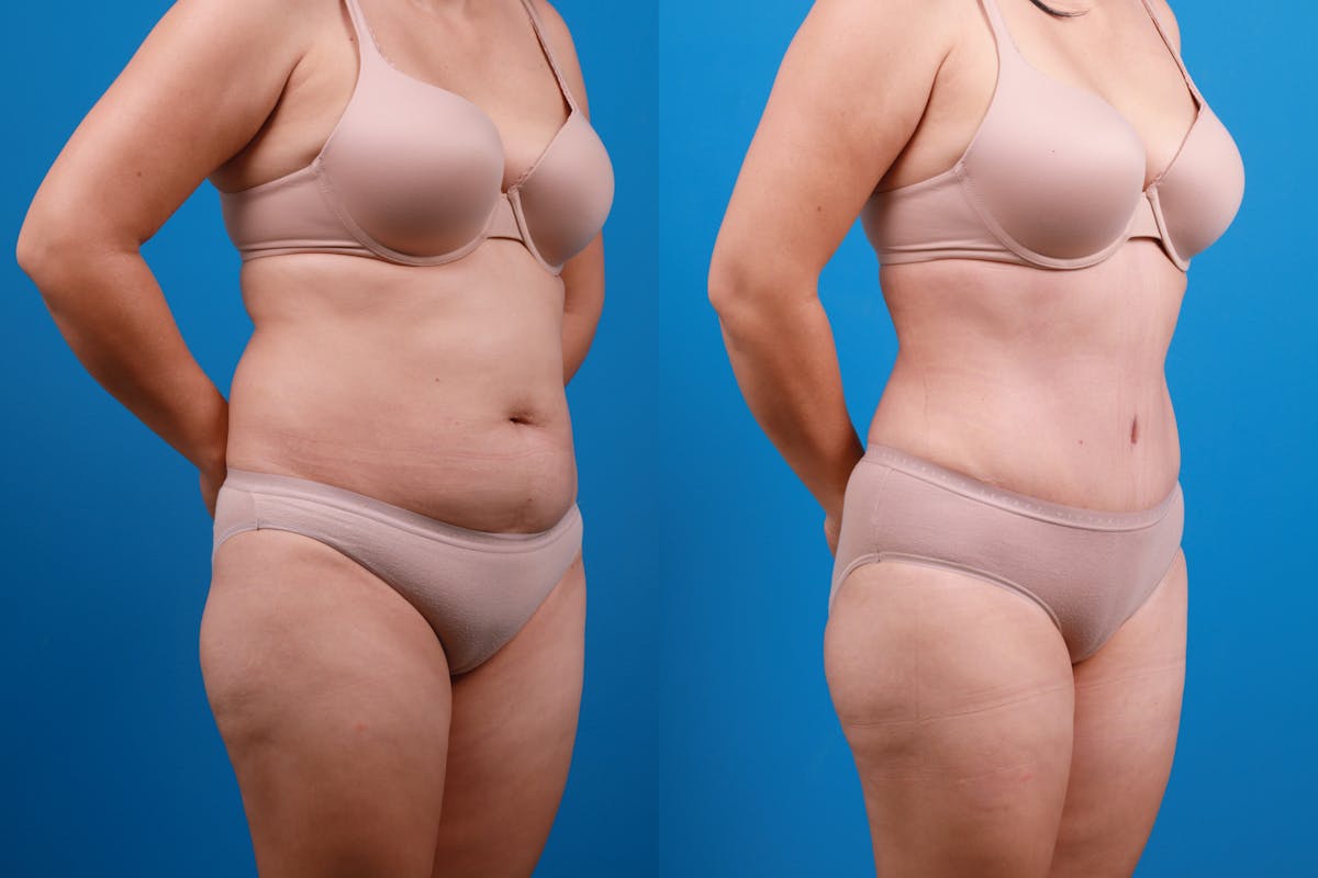 Tummy Tuck Before & After Gallery - Patient 115108 - Image 7