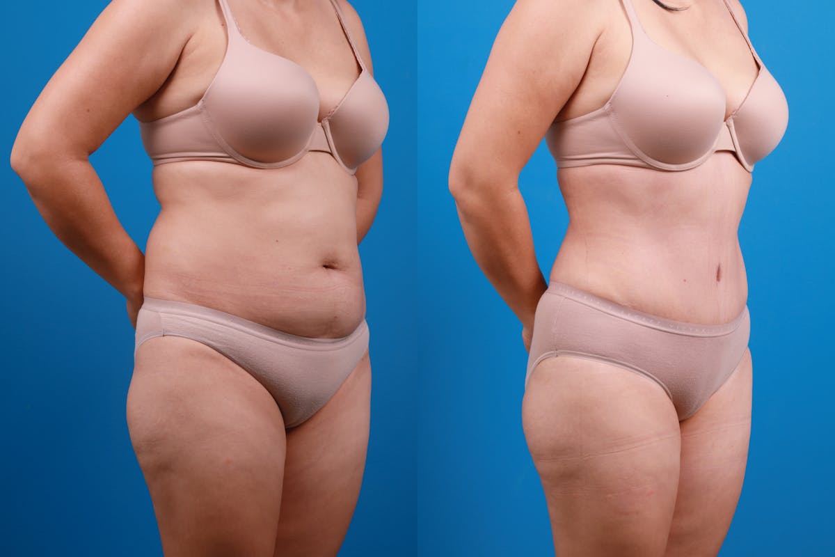Tummy Tuck Before & After Gallery - Patient 840104 - Image 7