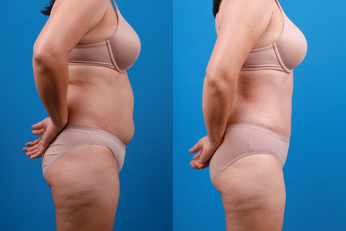 Tummy Tuck Before & After Gallery - Patient 840104 - Image 8