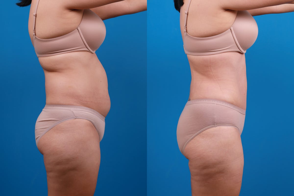 Tummy Tuck Before & After Gallery - Patient 840104 - Image 9