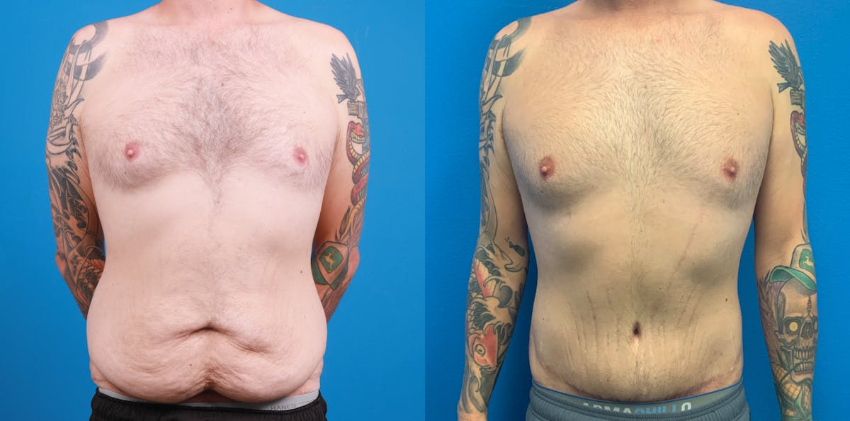 Tummy Tuck Before & After Gallery - Patient 121659 - Image 1
