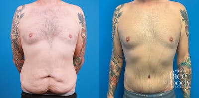 Hidden Tummy Tuck Before & After Gallery - Patient 312154 - Image 1