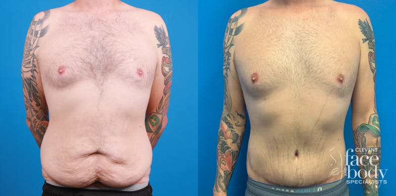 Hidden Tummy Tuck Before & After Gallery - Patient 312154 - Image 1