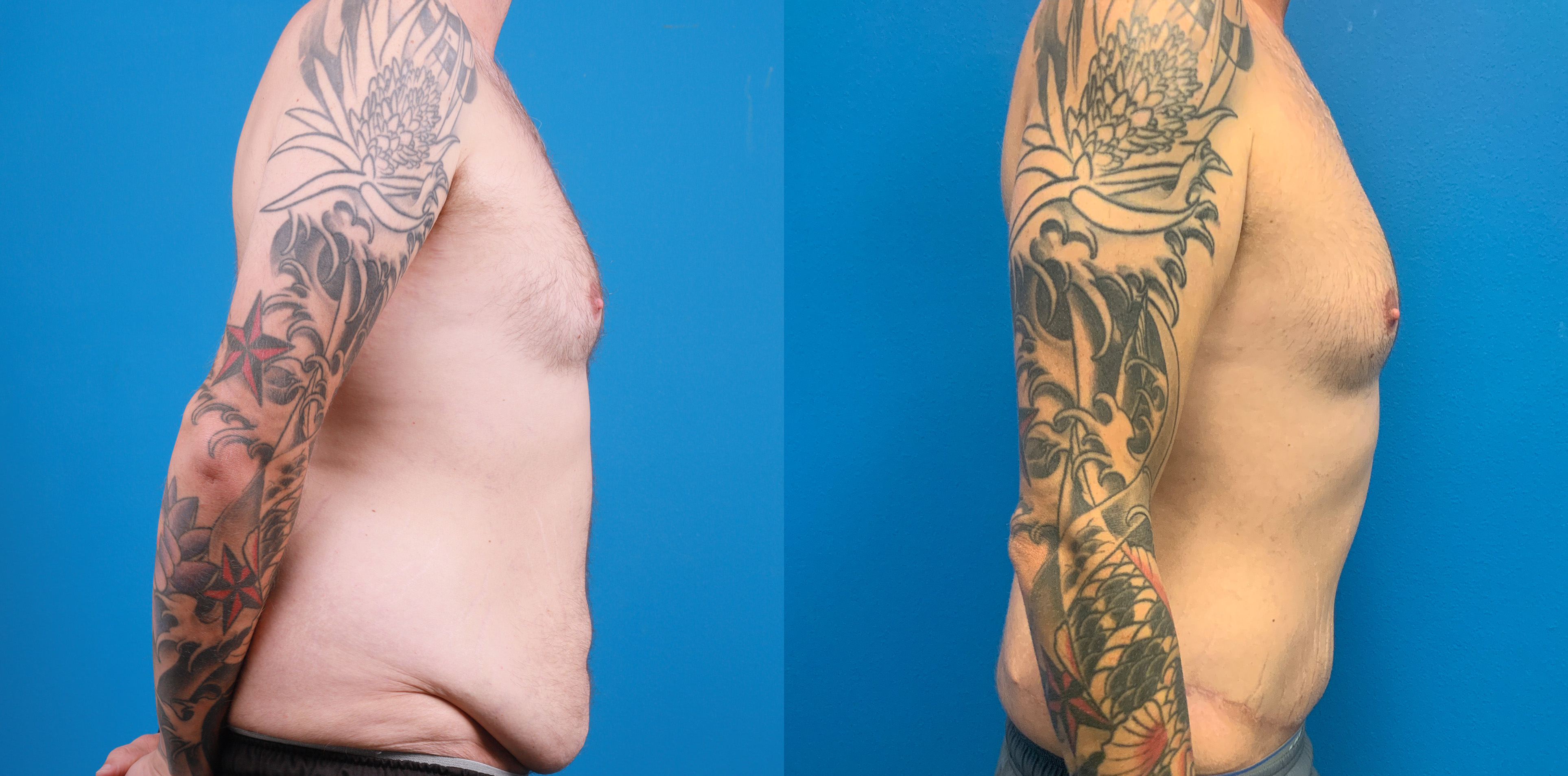 Hidden Tummy Tuck Before & After Gallery - Patient 312154 - Image 2