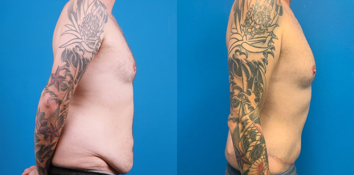 Tummy Tuck Before & After Gallery - Patient 996385 - Image 2