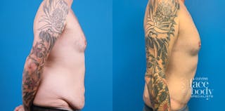 Hidden Tummy Tuck Before & After Gallery - Patient 312154 - Image 2