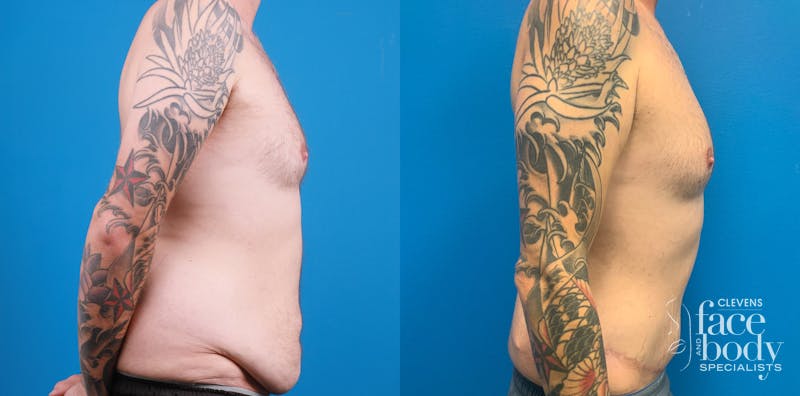 Hidden Tummy Tuck Before & After Gallery - Patient 312154 - Image 2