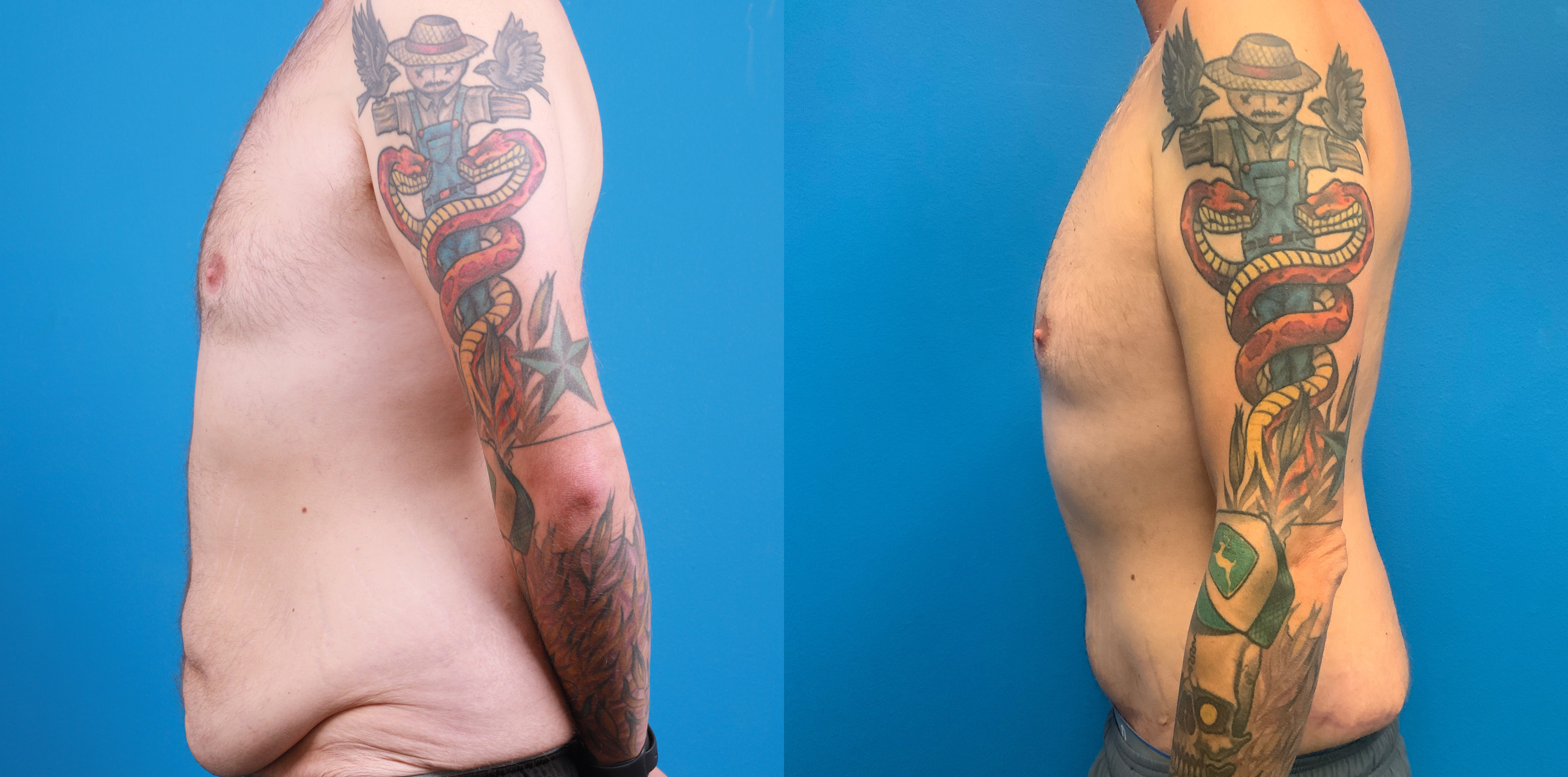 Hidden Tummy Tuck Before & After Gallery - Patient 312154 - Image 3