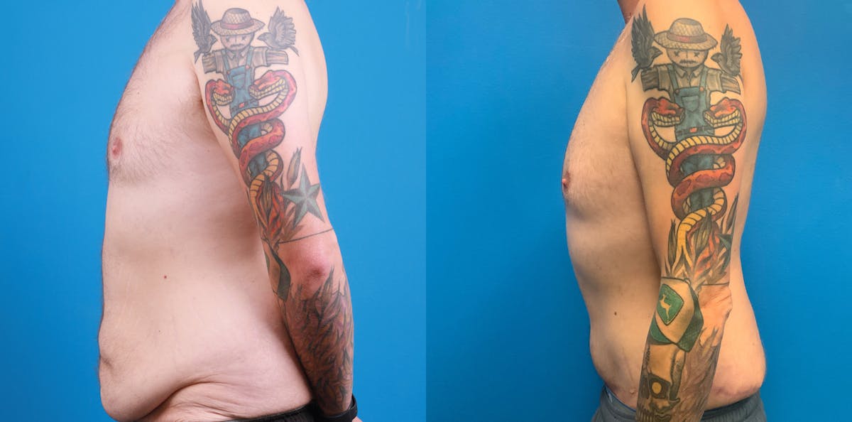 Tummy Tuck Before & After Gallery - Patient 996385 - Image 3