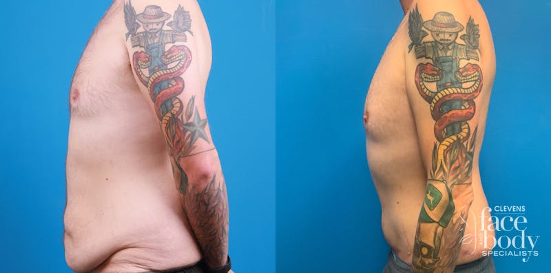 Hidden Tummy Tuck Before & After Gallery - Patient 312154 - Image 3