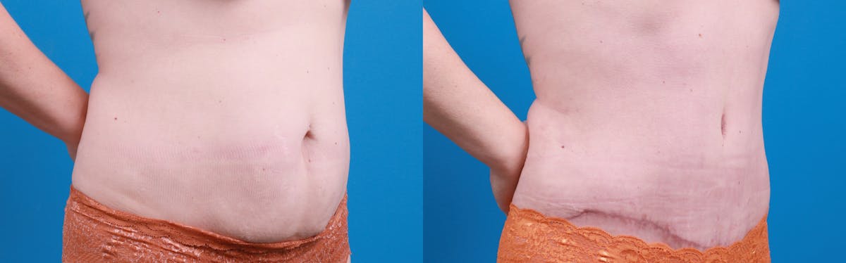 Tummy Tuck Before & After Gallery - Patient 112341 - Image 2