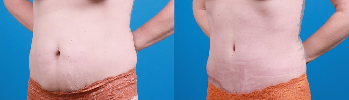 Tummy Tuck Before & After Gallery - Patient 112341 - Image 4