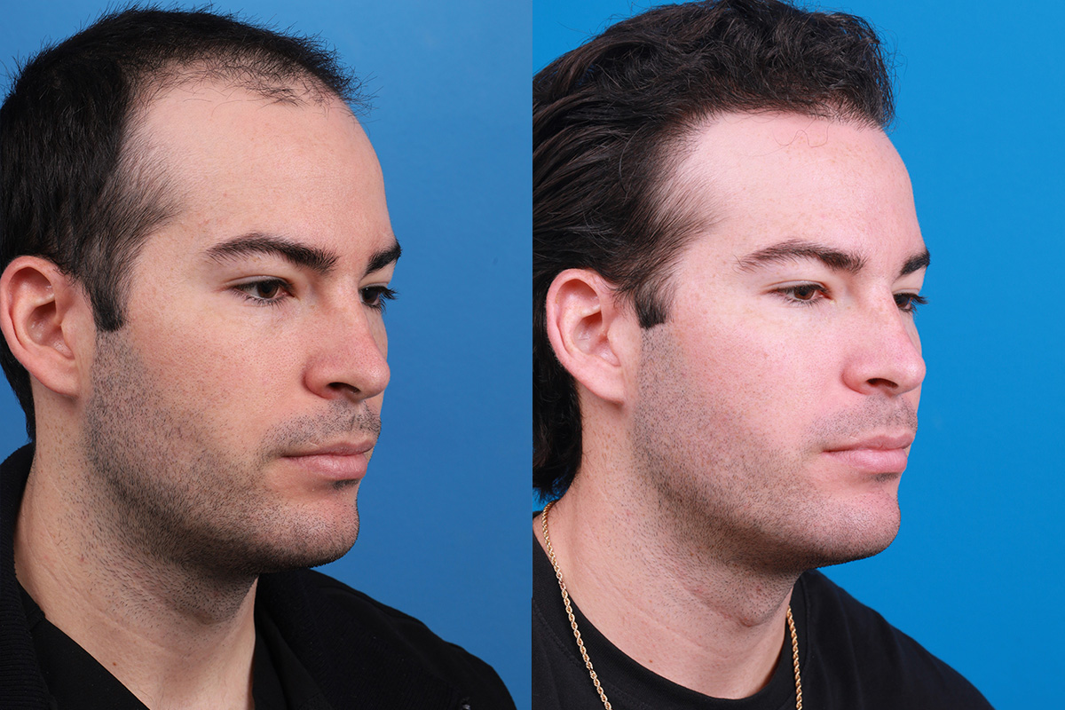 Before and after of man after hair restoration treatement