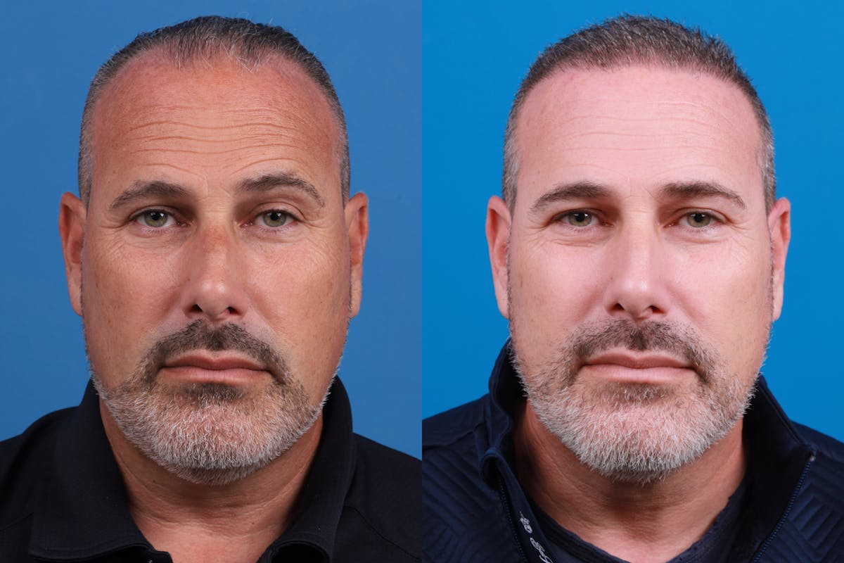 Hair Restoration Before & After Gallery - Patient 257756 - Image 3