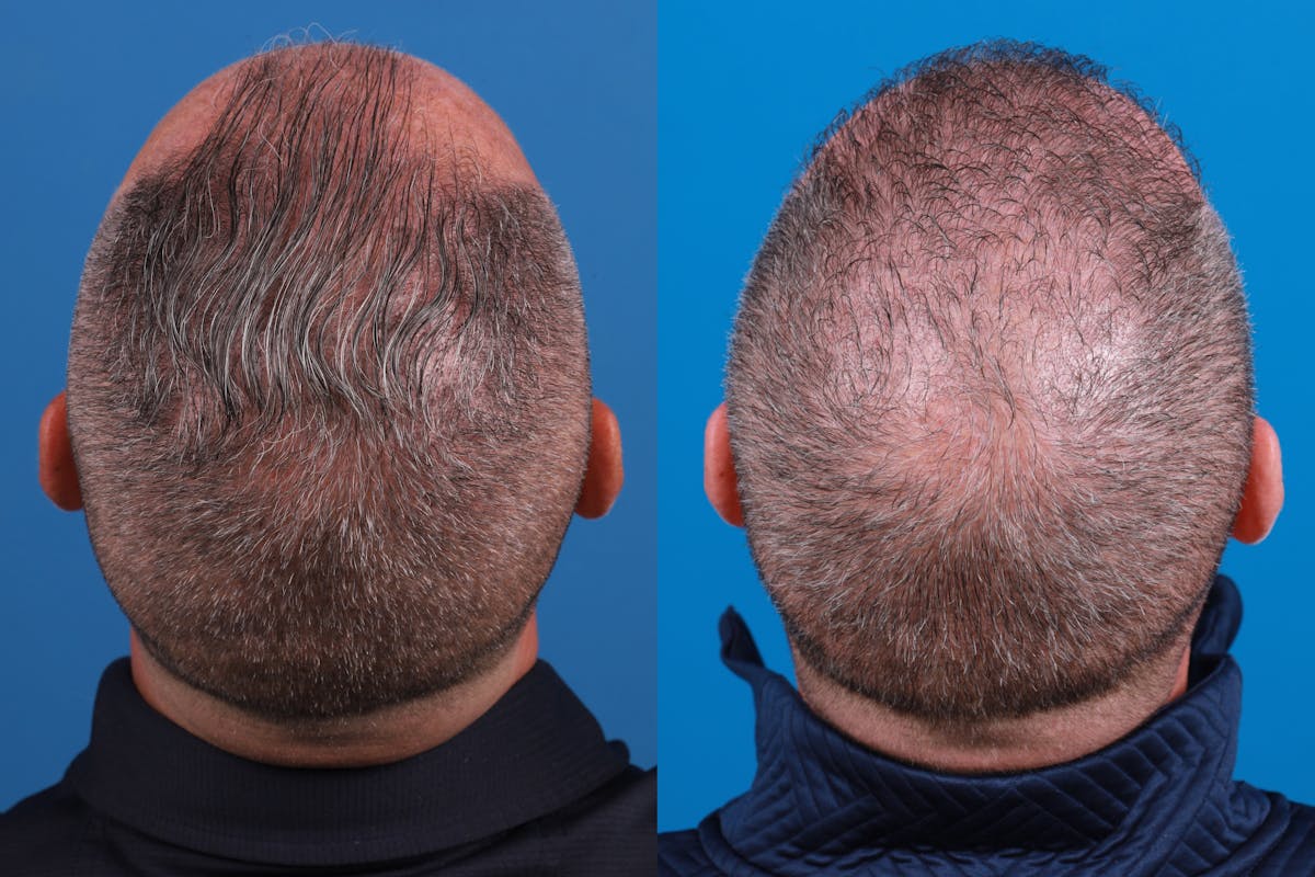 Hair Restoration Before & After Gallery - Patient 257756 - Image 2